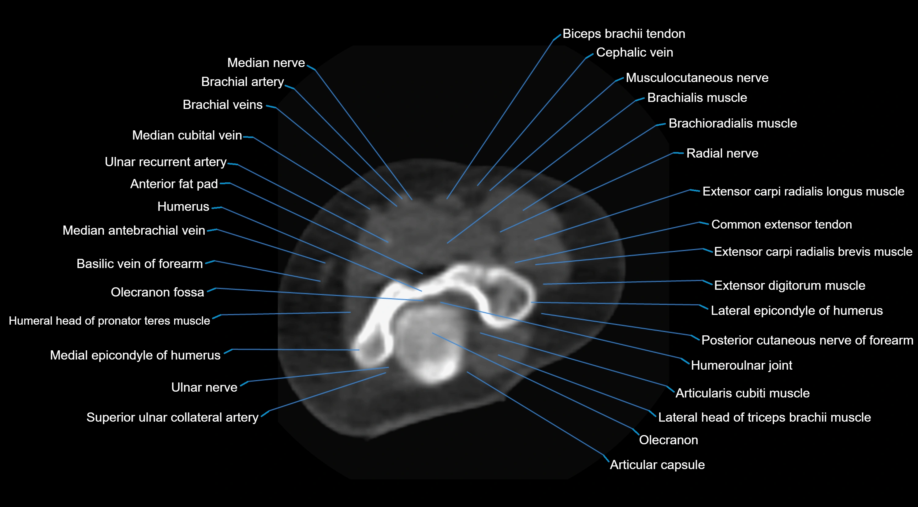 CT elbow axial  cross sectional anatomy labelled  radiology image -00016.webp